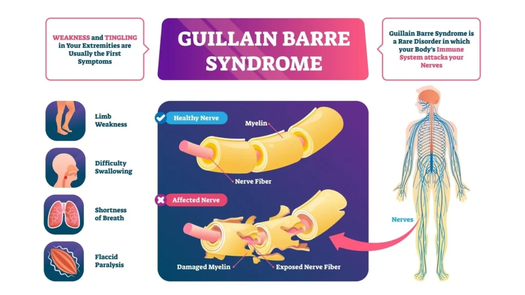 Guillain-Barré Syndrome Outbreak: Maharashtra and West Bengal Report Rising Cases